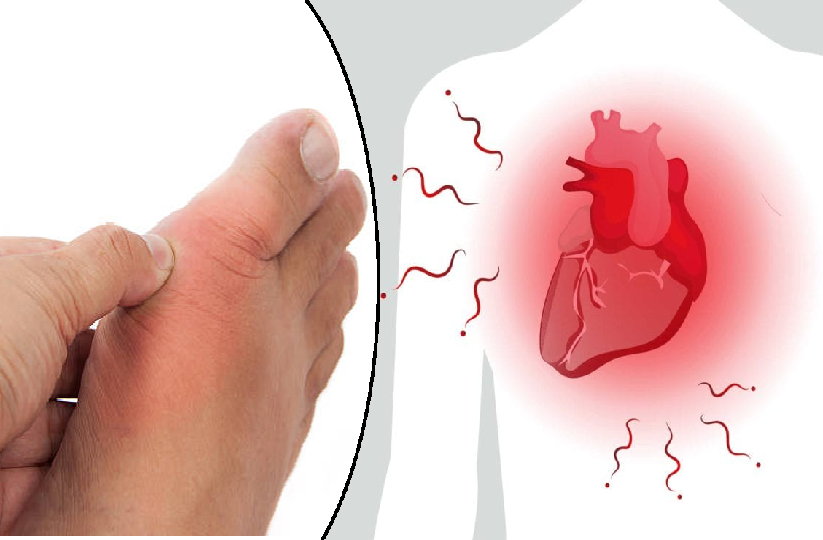 Thận trọng: Người bệnh gút có nguy cơ cao bị đột quỵ và đau tim