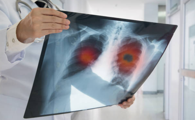 Những đối tượng nguy cơ mắc ung thư phổi và giải pháp tối ưu