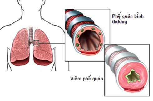 Những địa chỉ khám bệnh phổi tắc nghẽn mãn tính COPD uy tín hiện nay tại Hà Nội