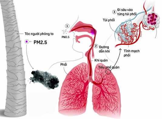 Bụi mịn rất dễ gây tổn thương phổi do có kích thước siêu nhỏ