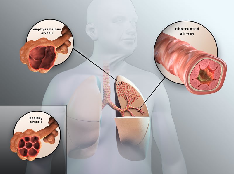 COPD Symptoms and Stages | Chronic Obstructive Pulmonary Disease