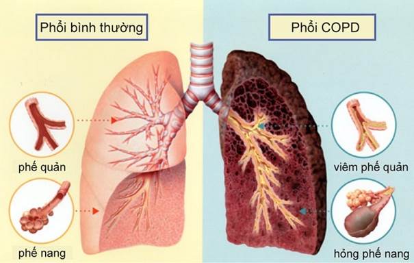 Bệnh phổi tắc nghẽn mãn tính COPD kiêng ăn gì và lời giải đáp từ chuyên gia