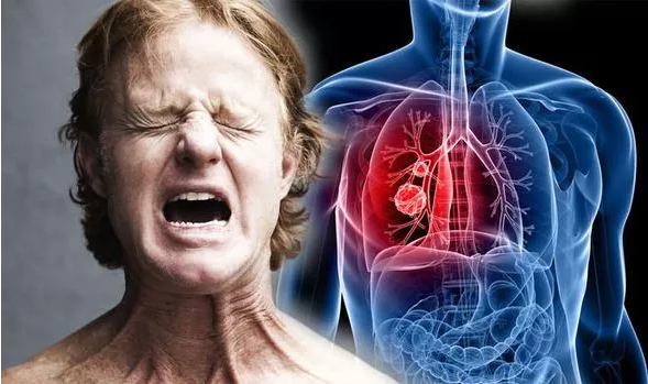 Người bệnh ung thư phổi phải chịu rất nhiều đau đớn, đặc biệt là ở giai đoạn cuối