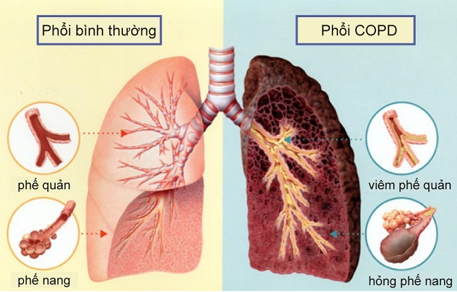 Bệnh phổi tắc nghẽn mạn tính (COPD) là gì? Những dấu hiệu nhận biết của bệnh.