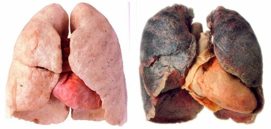 Phổi khỏe mạnh và phổi bị nhiễm độc