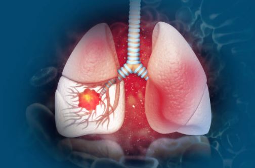 Người bệnh viêm phế quản mạn tính có nguy cơ rất cao mắc ung thư phổi