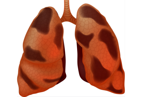 Phổi bị nhiễm độc gây bệnh COPD và làm bệnh nặng hơn