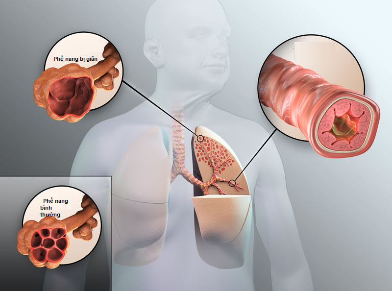 Phế nang và phế quản của người bệnh COPD