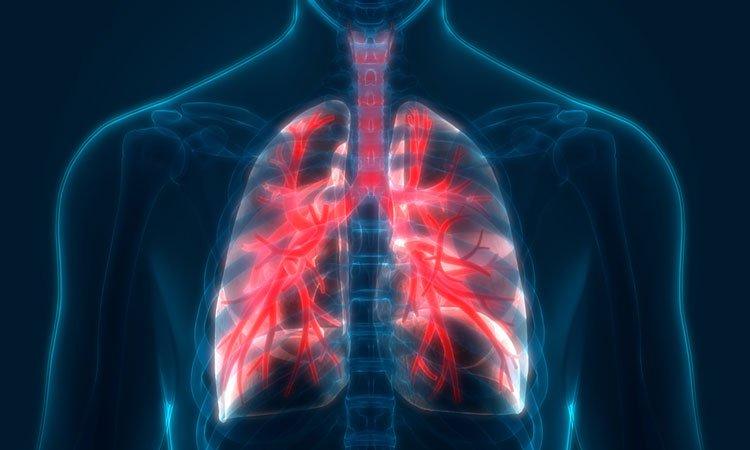 5 đồ uống giúp giải độc phổi cho người bệnh phổi tắc nghẽn mạn tính