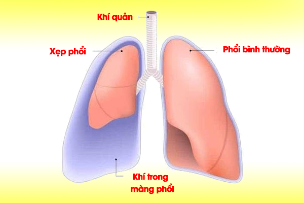 Tràn khí màng phổi gây xẹp phổi.
