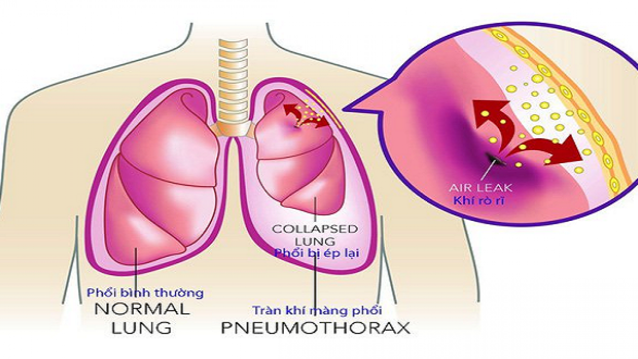 Tràn khí màng phổi đều là biến chứng của hen suyễn và COPD.