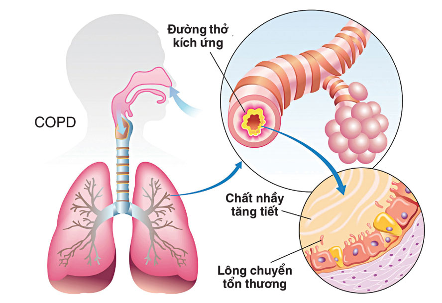  Bệnh phổi tắc nghẽn mãn tính gây tắc nghẽn đường thở