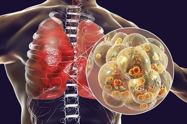 Tình trạng viêm phổi tái đi tái lại nhiều lần ở bệnh nhân COPD sẽ làm tăng nguy cơ ung thư phổi