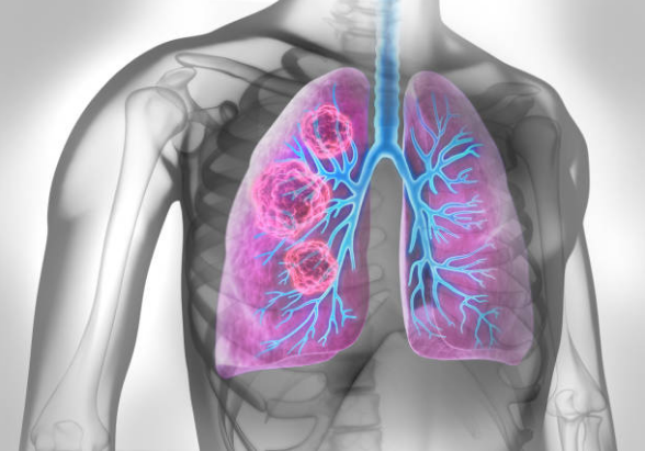 Mối nguy hại từ nhiễm độc phổi và biện pháp giúp giải độc phổi từ thảo dược