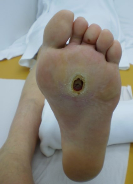 Loét chân ở bệnh nhân đái tháo đường