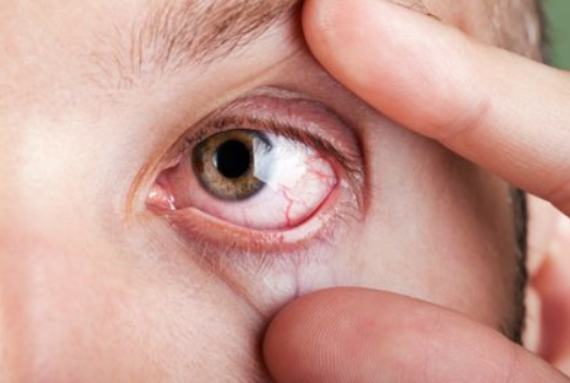 Bệnh võng mạc là nguyên nhân hàng đầu gây mù lòa