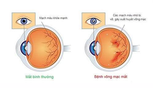 Bệnh võng mạc mắt có thể gây mù lòa ở bệnh nhân tiểu đường type 2