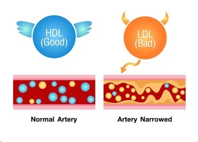 LDL là tác nhân gây các bệnh tim mạch.