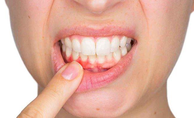 Tìm hiểu về các vấn đề răng miệng ở bệnh nhân tiểu đường