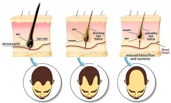 DHT- Nguyên nhân chính gây rụng tóc ở nam giới