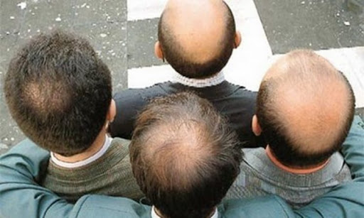 Tóc rụng nhiều do di truyền, đặc biệt là tình trạng hói đầu ở nam giới