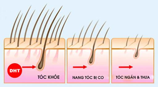 DHT- Nguyên nhân chính gây rụng tóc
