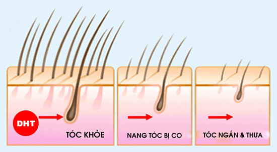 DHT- Nguyên nhân chính gây ra tình trạng tóc rụng nhiều