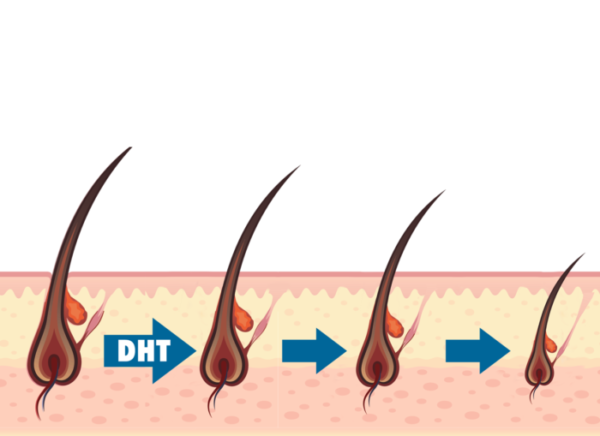 DHT- Nguyên nhân chính khiến chân tóc yếu dễ gãy rụng ở cả nam và nữ