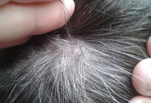 Nhổ tóc bạc có hại gì?