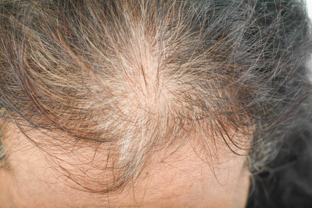Nhổ tóc bạc tăng nguy cơ hói đầu