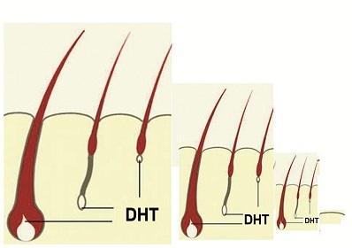 DHT là nguyên nhân gây rụng tóc tuổi tiền mãn kinh.