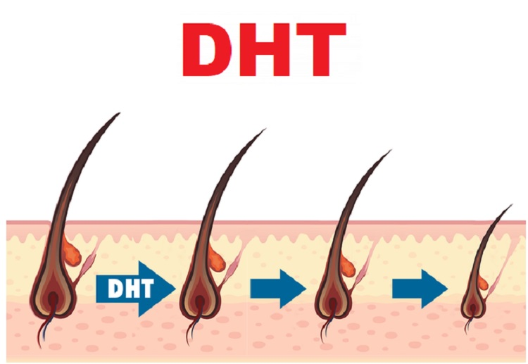  DHT là thủ phạm gây rụng tóc nhiều, hói đầu sớm