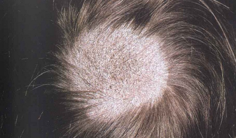 Rụng tóc sau khi bị nấm
