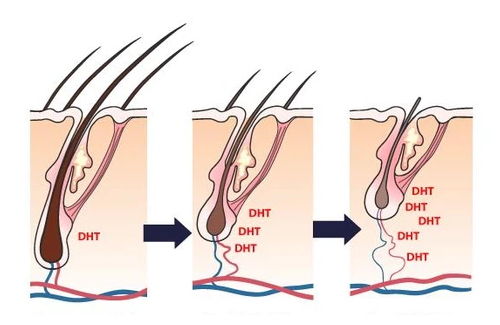DHT là nguyên nhân rụng tóc nhiều thường gặp nhất