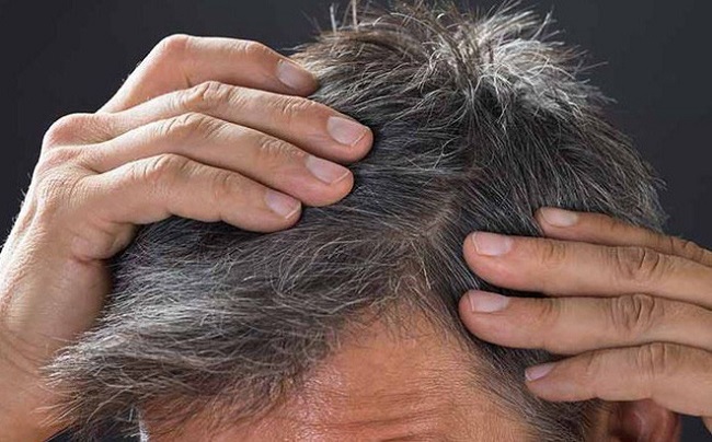 Những nguyên nhân gây bạc tóc sớm ở nam giới