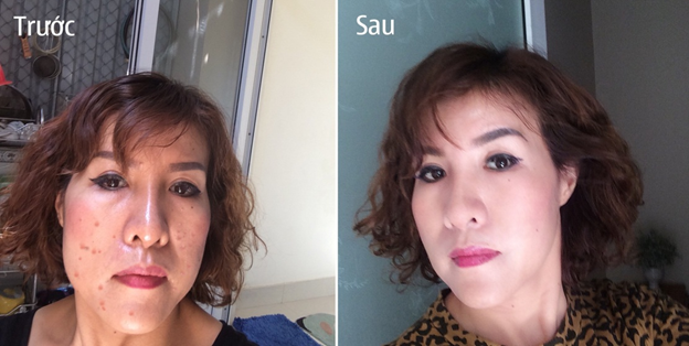 Làn da trước và sau khi dùng BoniSnow của chị Dương