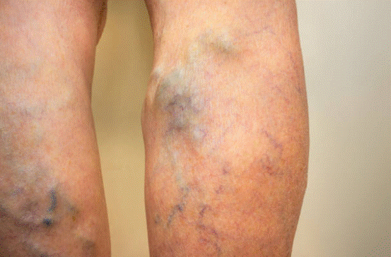 Nổi gân xanh ở chân là dấu hiệu điển hình của bệnh suy giãn tĩnh mạch chi dưới