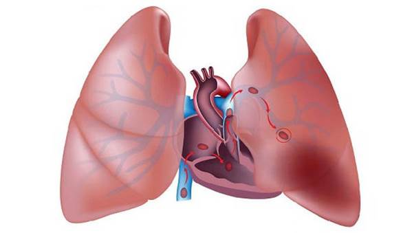 Thuyên tắc mạch phổi là biến chứng nguy hiểm của suy giãn tĩnh mạch