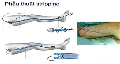 Phương pháp phẫu thuật stripping