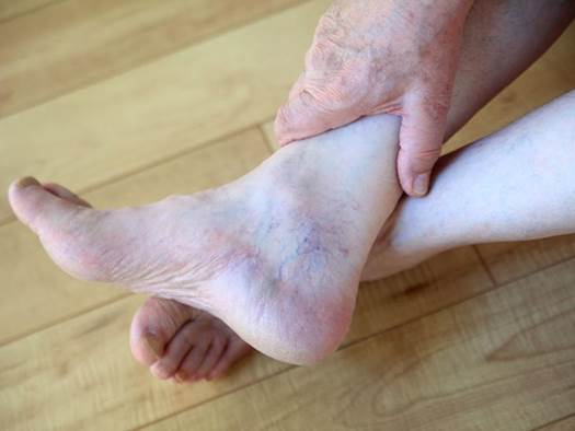 Suy giãn tĩnh mạch bàn chân là bệnh gì ? Có nguy hiểm không?