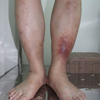 Hình ảnh bệnh nhân loét chân