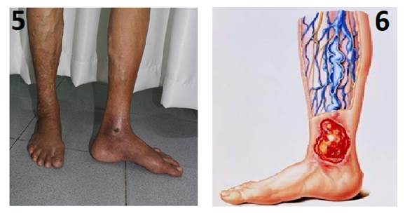 Hình ảnh suy giãn tĩnh mạch chân ở độ 5 và độ 6
