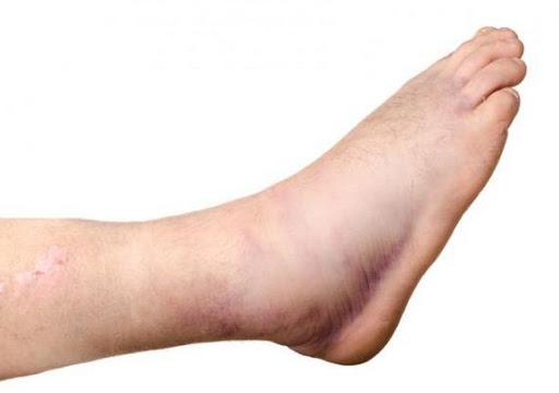 Người bệnh thường bị sưng phù, thường ở xung quanh mắt cá chân và bàn chân