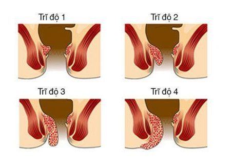 4 phân độ của trĩ nội