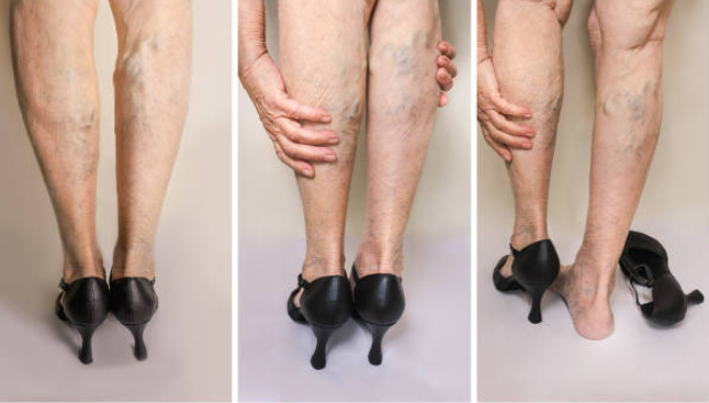 Đau chân, nhức mỏi chân là biểu hiện thường gặp của bệnh suy giãn tĩnh mạch