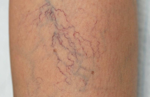 Tĩnh mạch mạng nhện ở chân là dấu hiệu của bệnh lý nguy hiểm