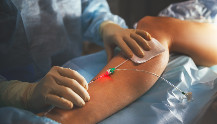 Phương pháp laser nội tĩnh mạch