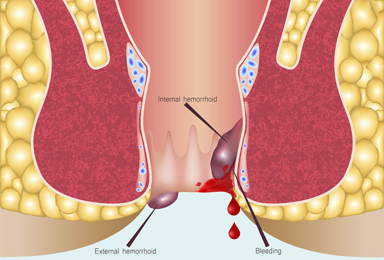 Biến chứng chảy máu kéo dài của bệnh trĩ