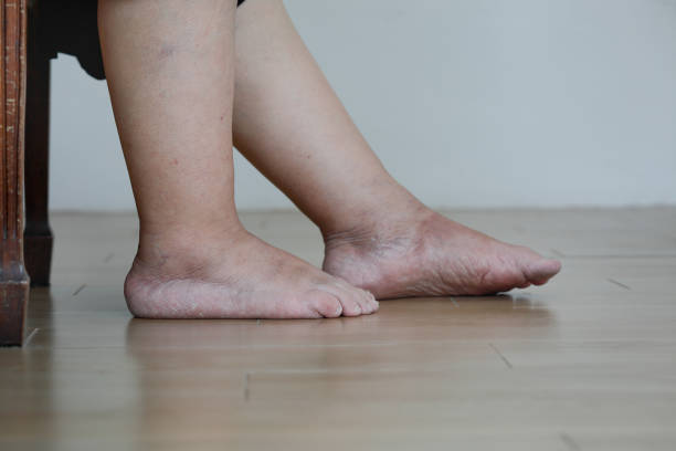 Sưng phù chân cản trở đi lại và ảnh hưởng lớn đến sinh hoạt của người bệnh