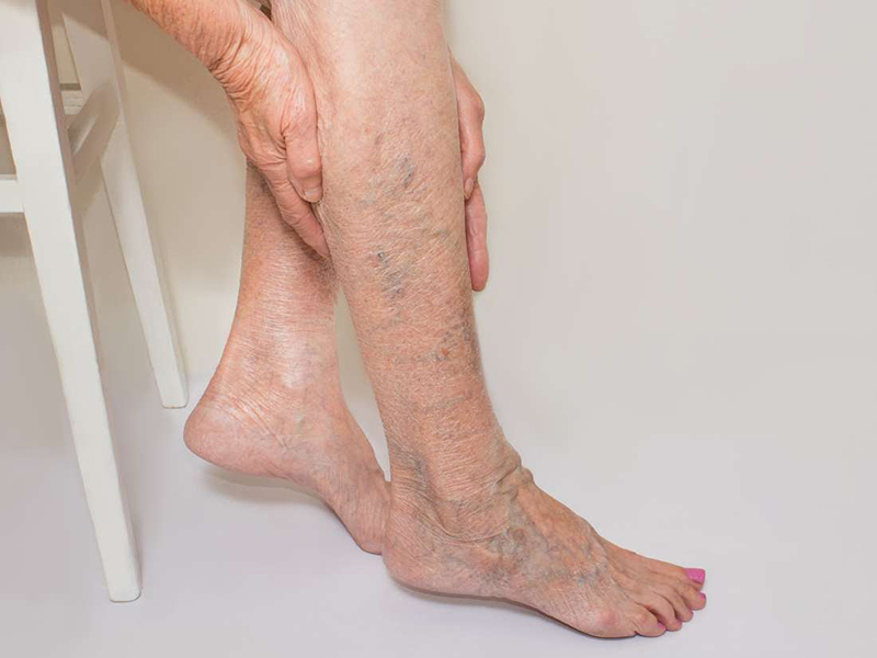 Hình ảnh thường gặp ở người bệnh suy giãn tĩnh mạch chân